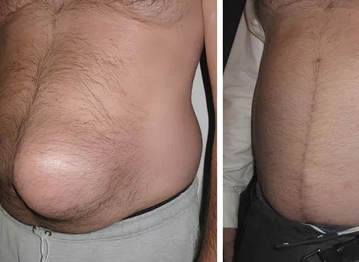 Epigastric Hernia consultation at Niraaya Hospital
